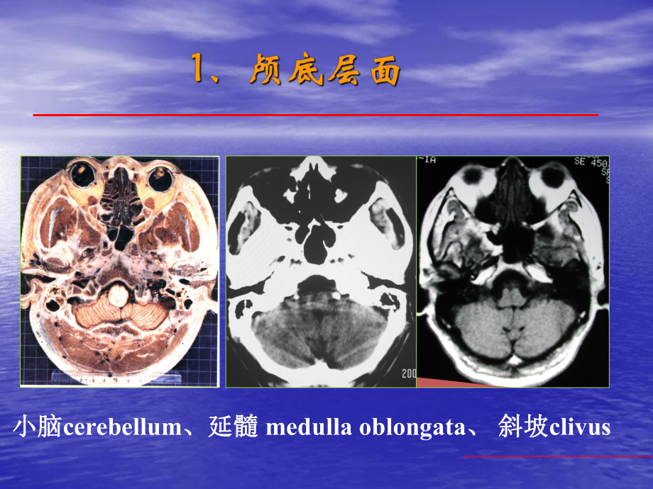 康复科主要影像学阅片课件.ppt_第3页