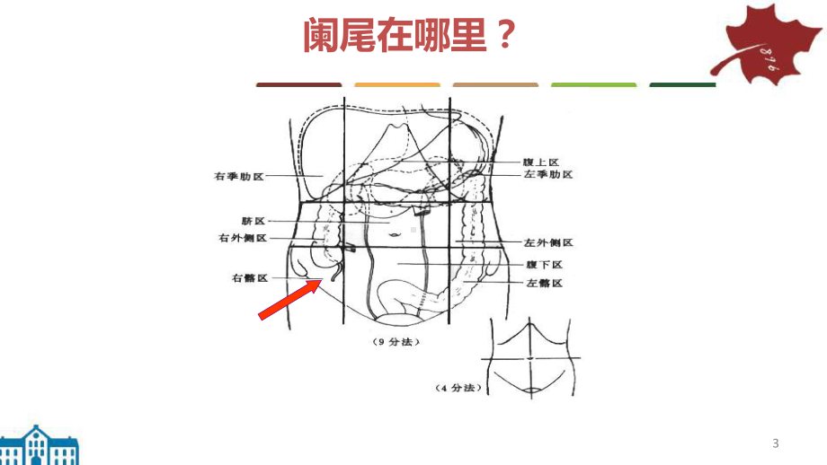 急性阑尾炎病人的护理PPT课件.ppt_第3页