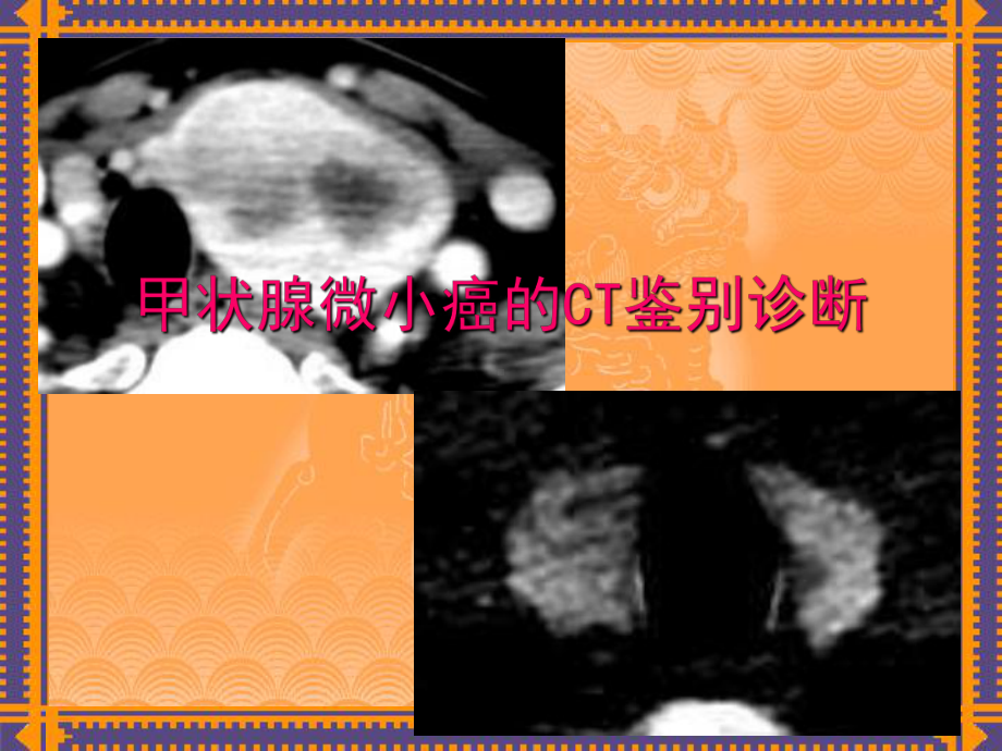 甲状腺病变CT诊断知识课件.ppt_第1页