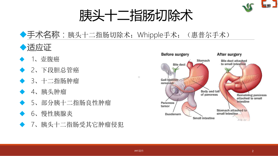 胰腺、十二指肠手术麻醉-ppt课件.ppt_第2页