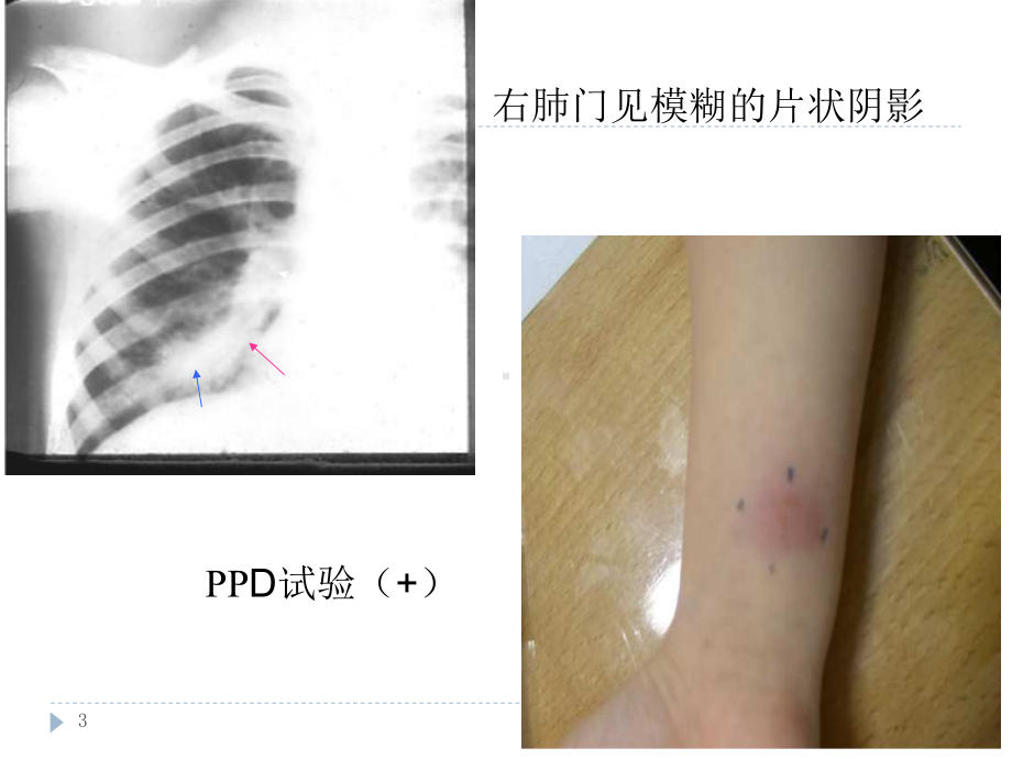 结核病病理学PPT课件.ppt_第3页