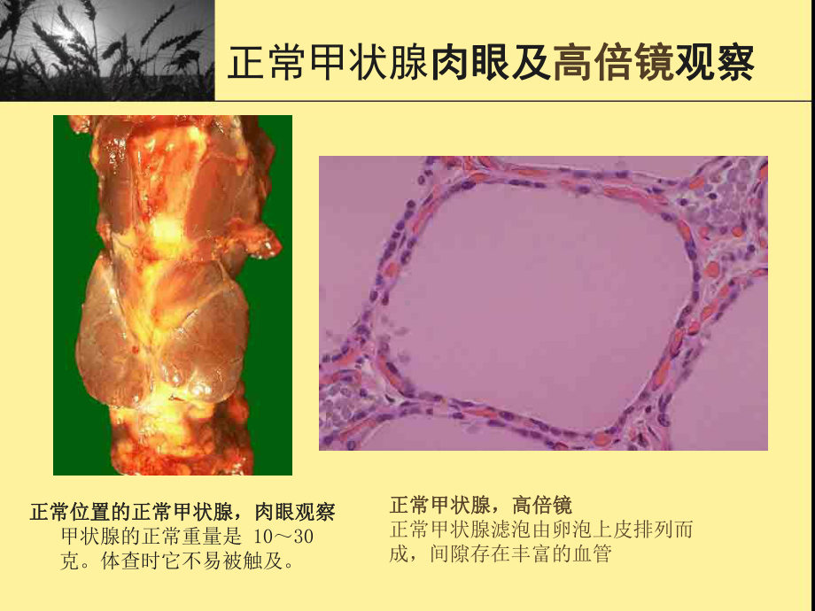 甲状腺超声李凤华上海课件.ppt_第3页