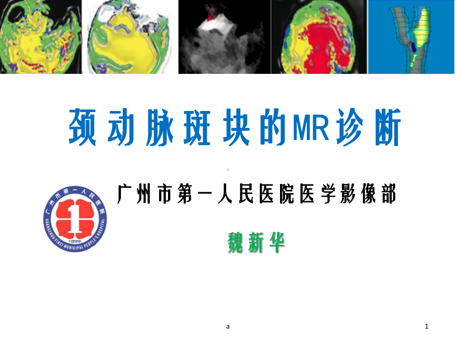 颈动脉斑块的MR诊断课件.ppt_第1页