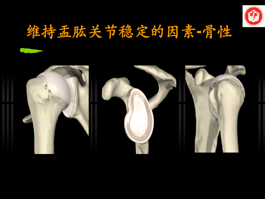 不可复性前脱位肩关节课件.ppt_第3页