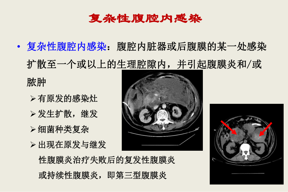 复杂性腹腔感染的处理课件.ppt_第2页