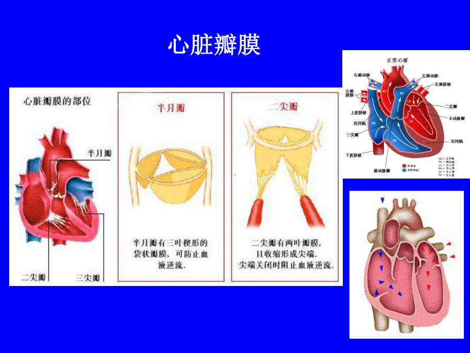 二尖瓣球囊成形术示意图课件.ppt_第2页