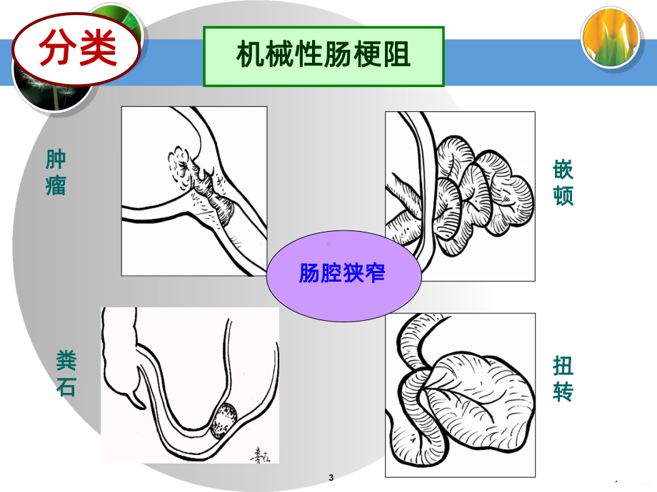 麻痹性肠梗阻查房PPT课件.ppt_第3页