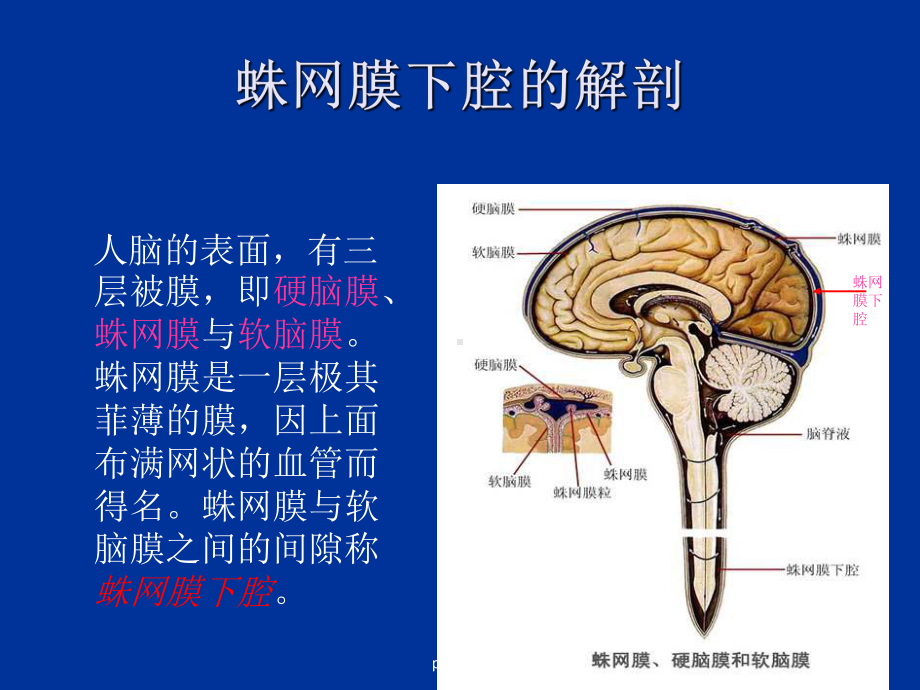 创伤性蛛网膜下腔出血ppt课件.ppt_第3页