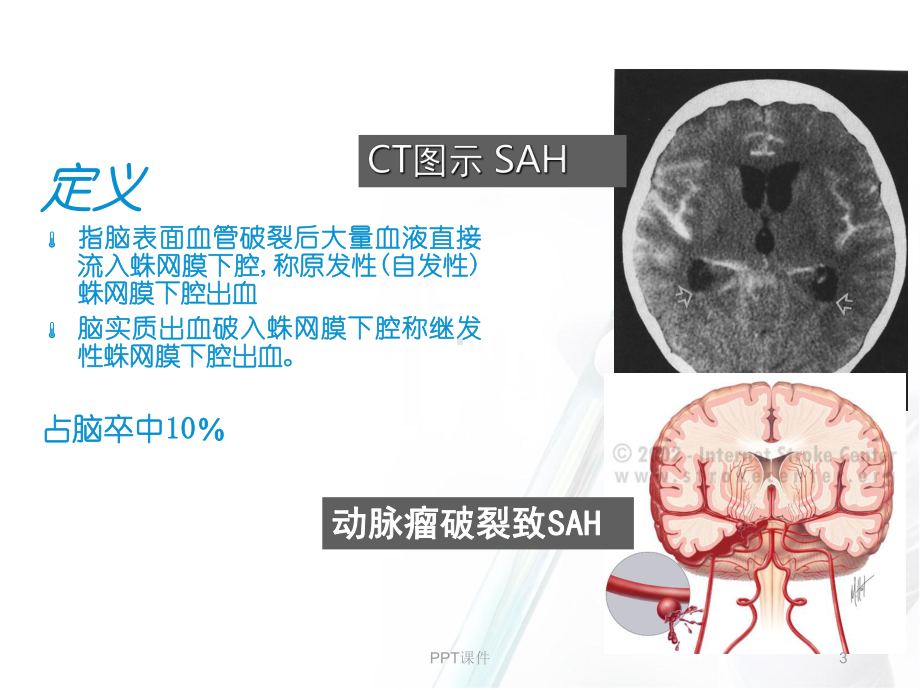 蛛网膜下腔出血-PPT课件.ppt_第3页