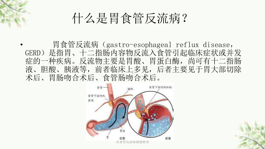 胃食管反流病健康教育课件.ppt_第2页