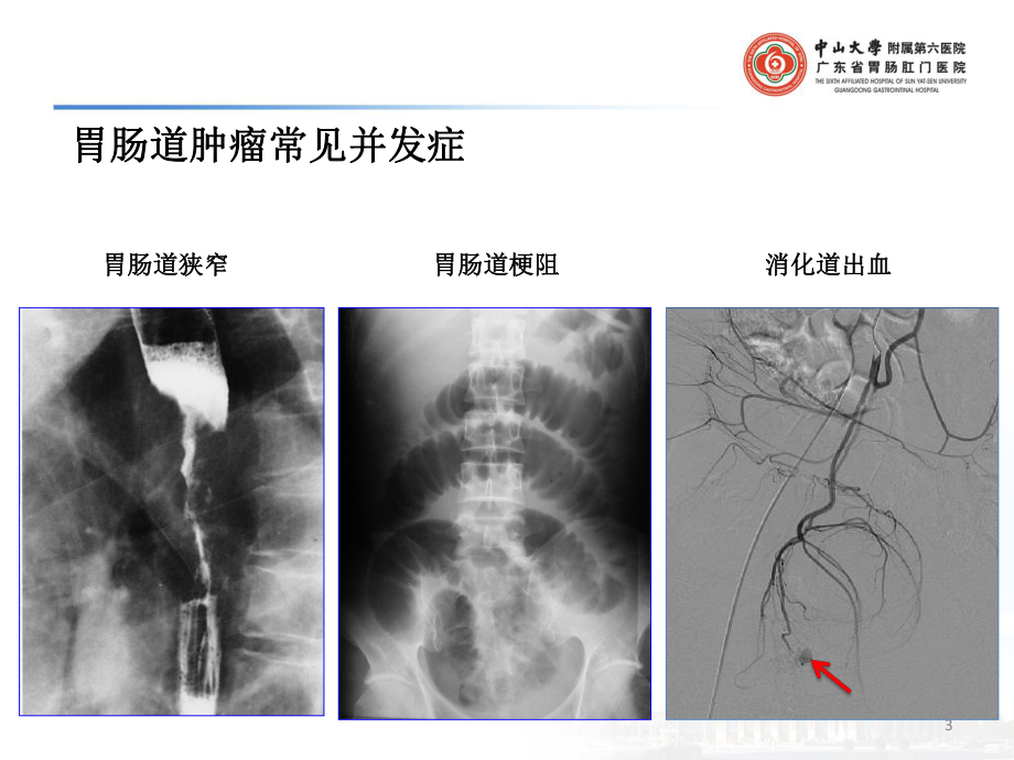 胃肠道肿瘤常见并发症介入治疗PPT课件.ppt_第3页