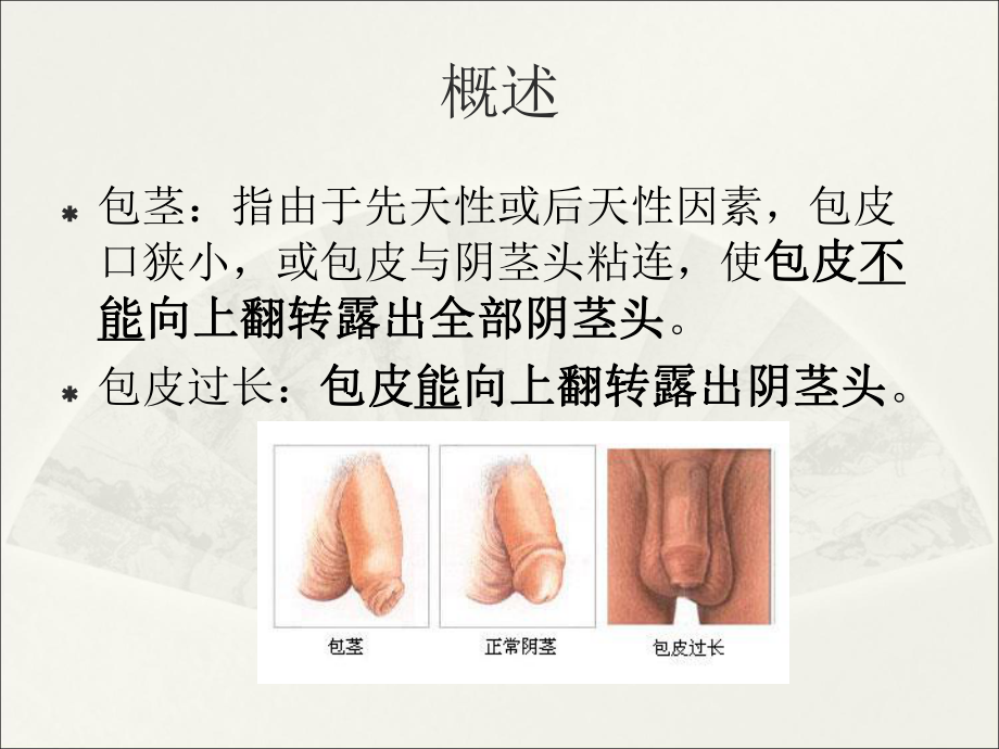 包茎包皮过长ppt课件.ppt_第2页