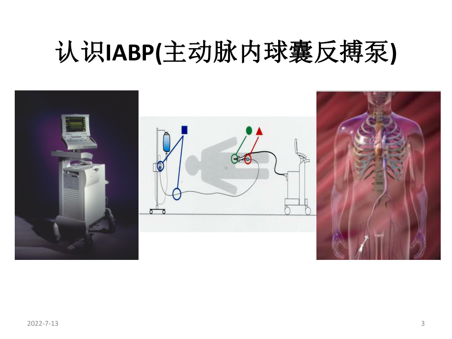 IABP主动脉球囊反搏PPT课件.pptx_第3页