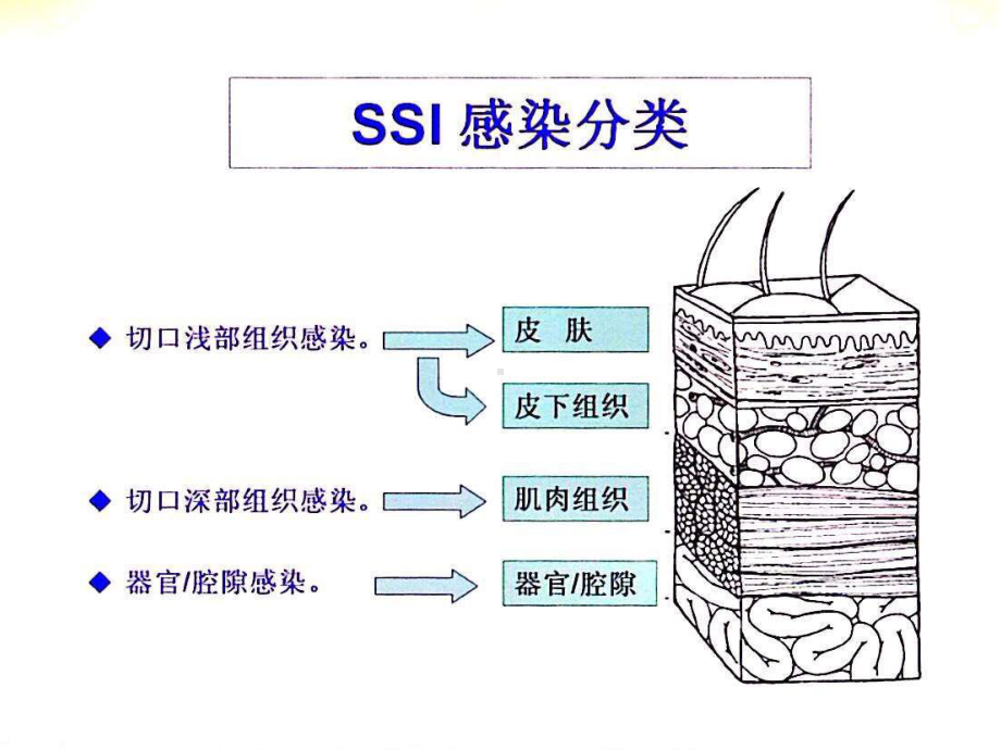 手术部位感染预防与控制课件.ppt_第3页