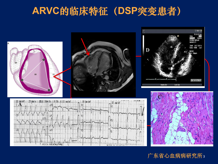 心律失常右室心肌病基础与临床简介PPT课件.pptx_第3页