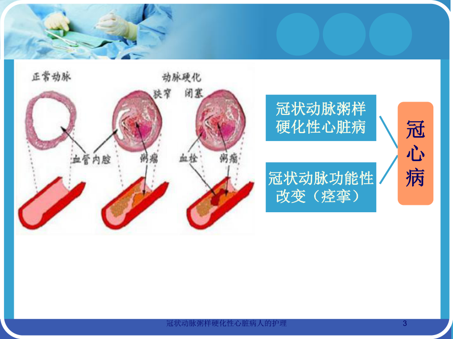 冠状动脉粥样硬化性心脏病人的护理培训课件.ppt_第3页