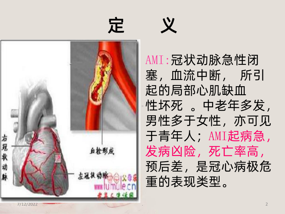 急性心肌梗死的护理新进展PPT课件.ppt_第2页