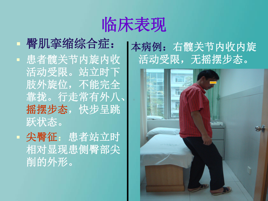 臀肌挛缩综合症.ppt课件.ppt_第3页