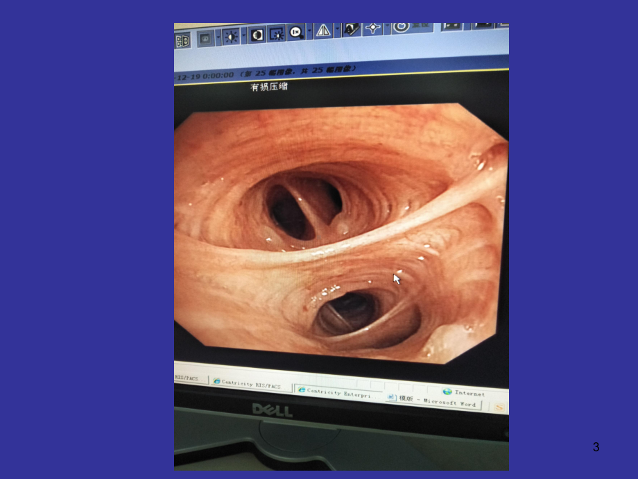 支气管镜的临床应用PPT课件.ppt_第3页
