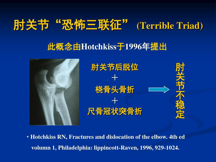 肘关节恐怖三联征的规范化治疗共73页文档课件.ppt_第2页