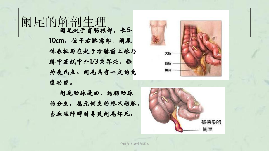 护理查房急性阑尾炎课件.ppt_第3页