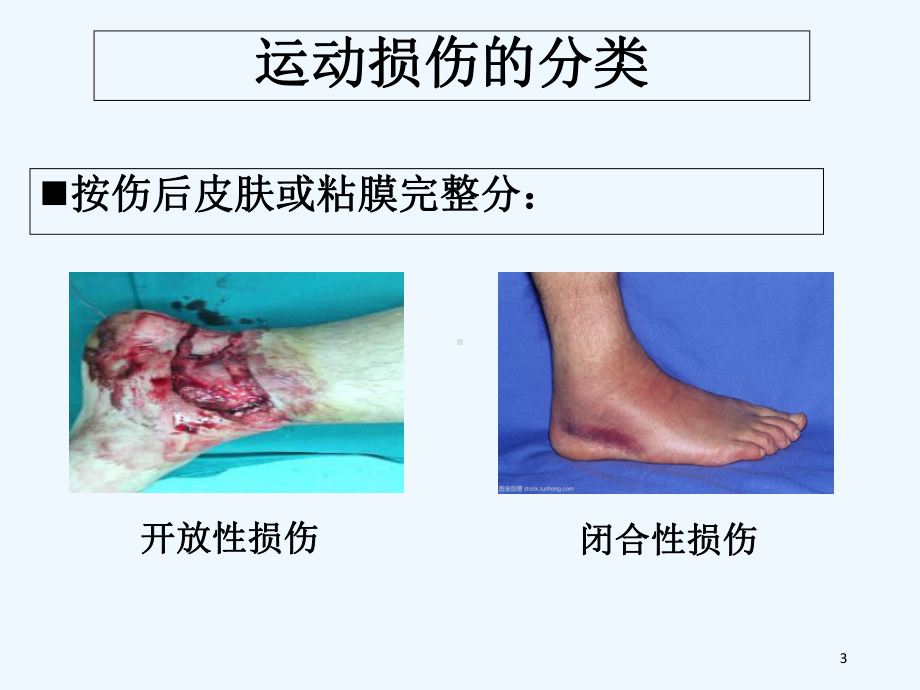 常见运动损伤的预防与处理-PPT课件.ppt_第3页