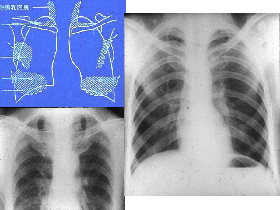 诊断学X线常见影像学读片课件.ppt_第3页