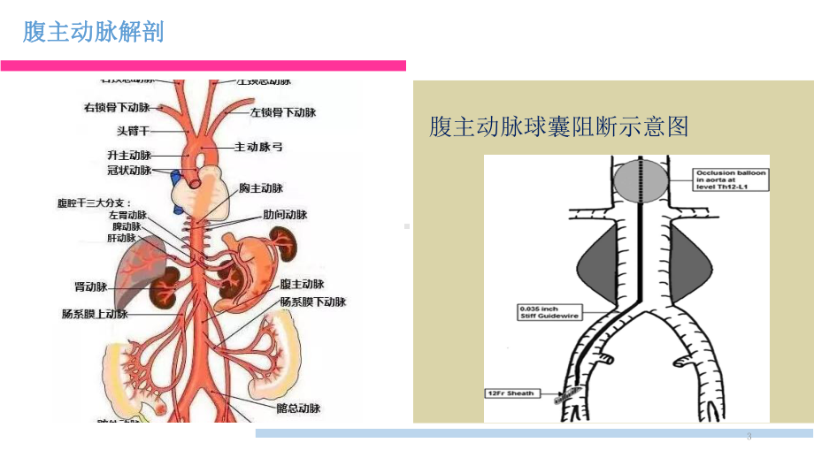 腹主动脉阻断术PPT课件.pptx_第3页