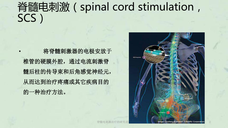 脊髓电刺激治疗的研究进展课件.ppt_第2页