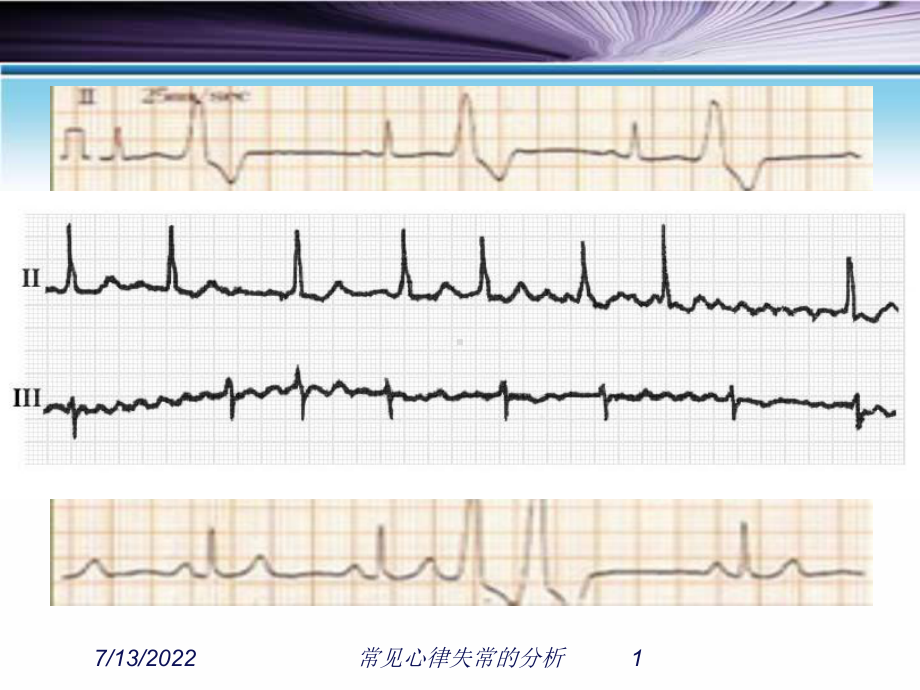 常见心律失常的分析课件.ppt_第1页