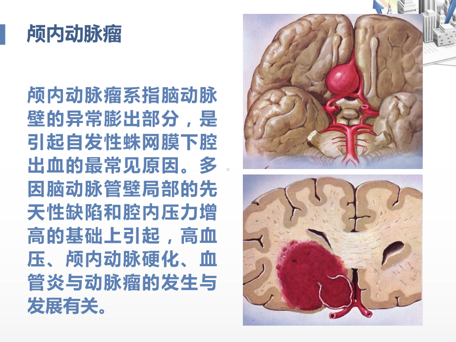 动脉瘤病人护理查房-ppt课件.ppt_第2页