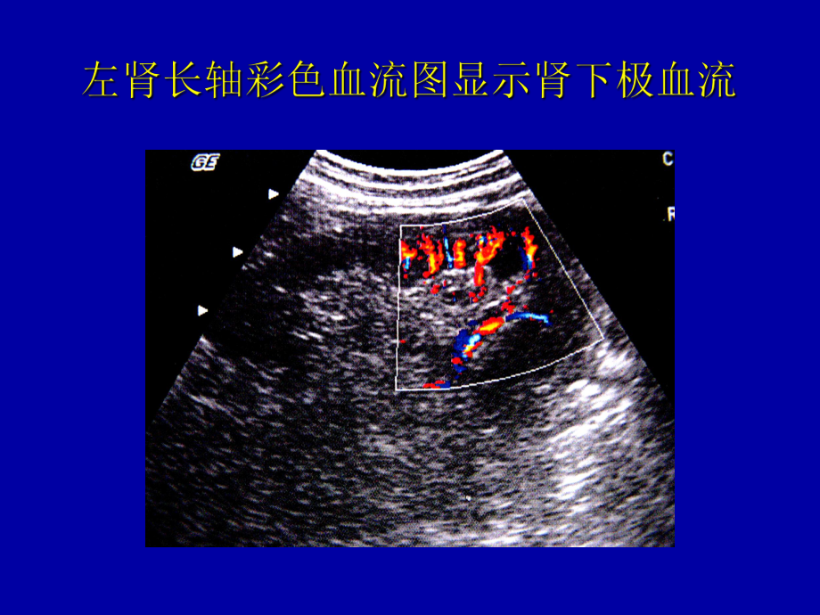 急性肾动脉栓塞-PPT课件.ppt_第3页