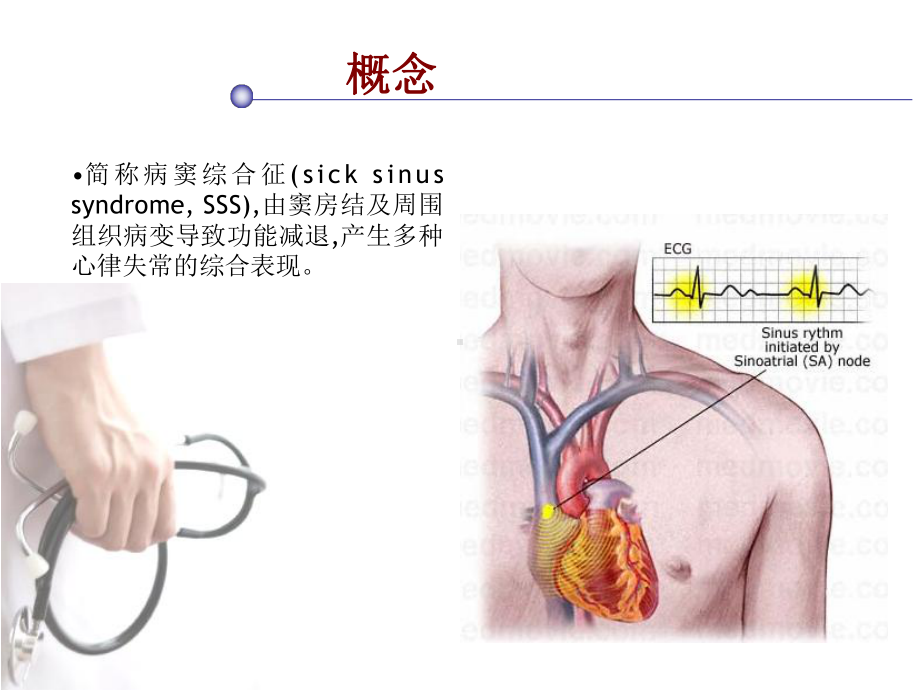 病态窦房结综合征PPT课件.ppt_第2页