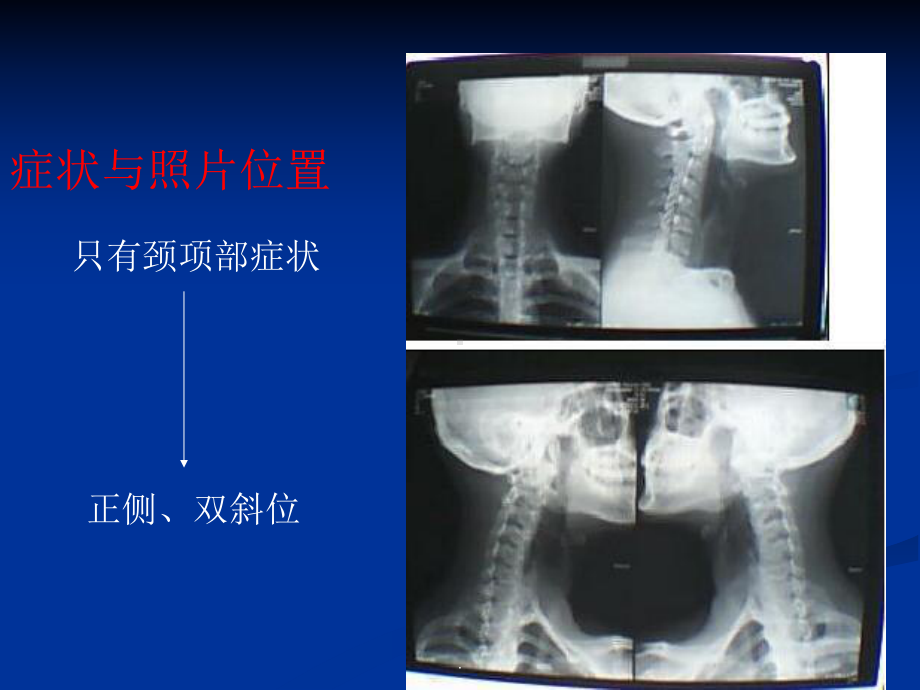 颈椎X光片阅读课件.ppt_第3页