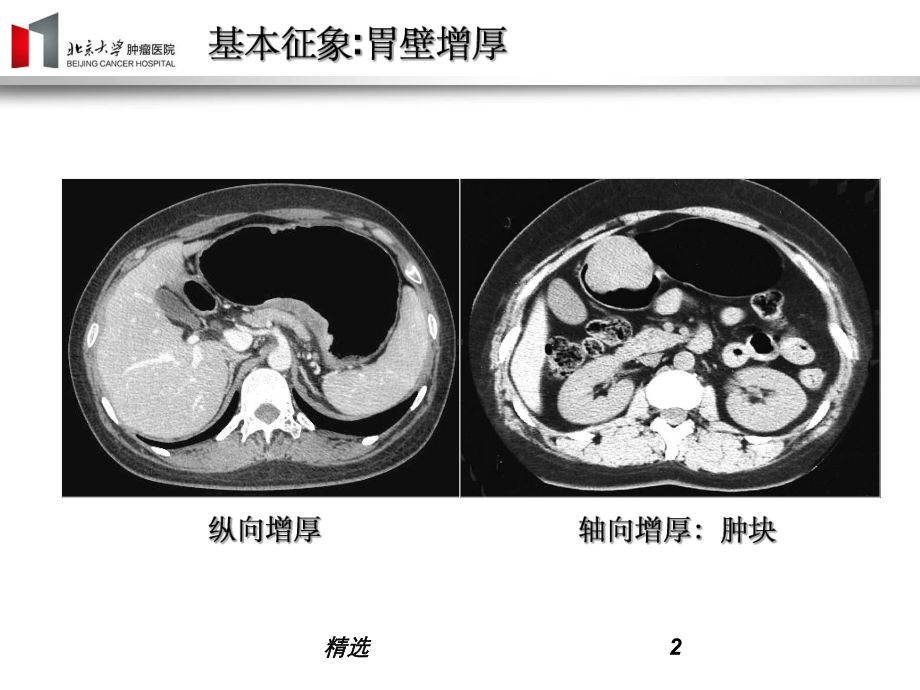 胃癌影像诊断ppt课件.ppt_第2页