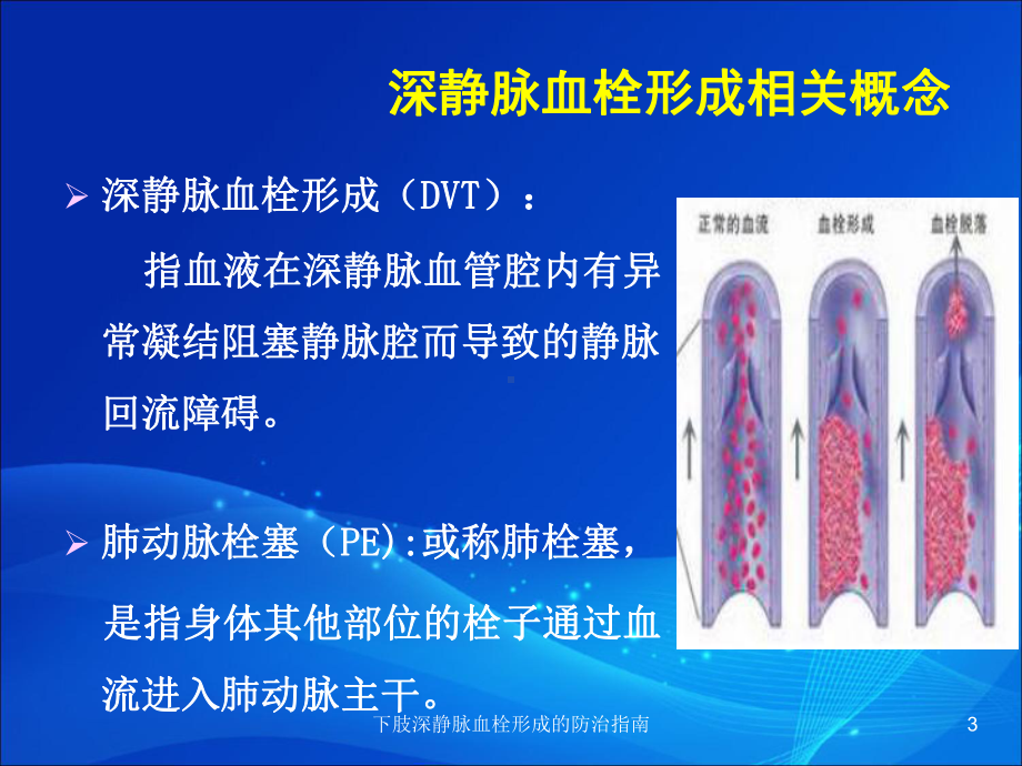 下肢深静脉血栓形成的防治指南培训课件.ppt_第3页