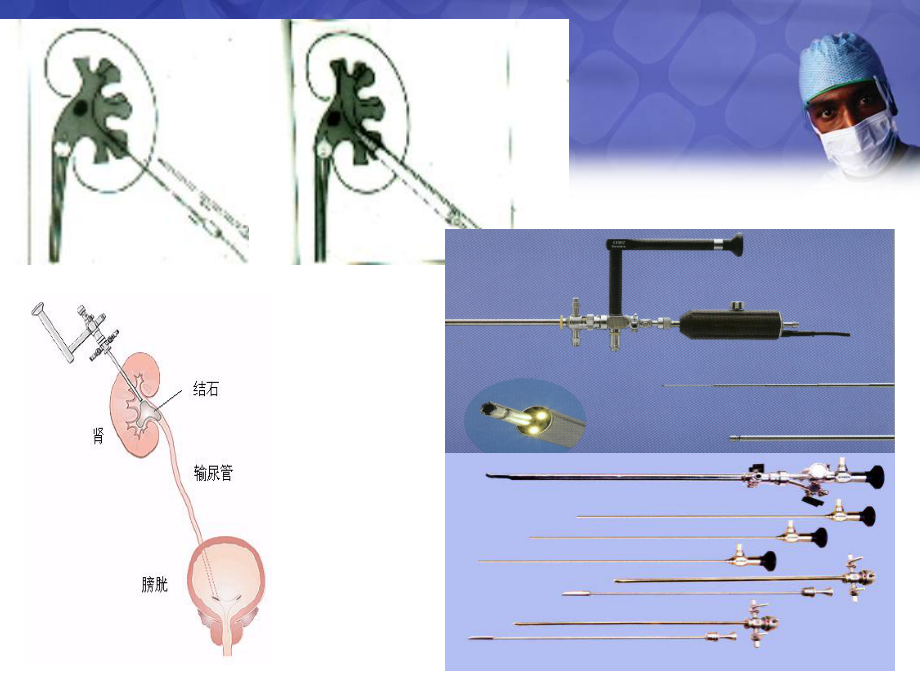 经皮肾镜手术讲解PPT课件.ppt_第3页