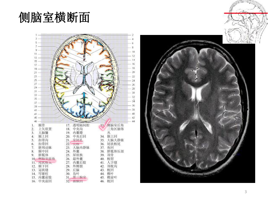 室管膜瘤PPT课件.ppt_第3页