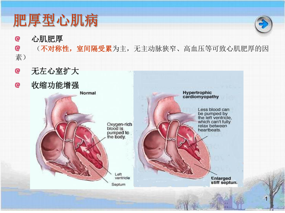 肥厚型心肌病PPT课件.ppt_第1页