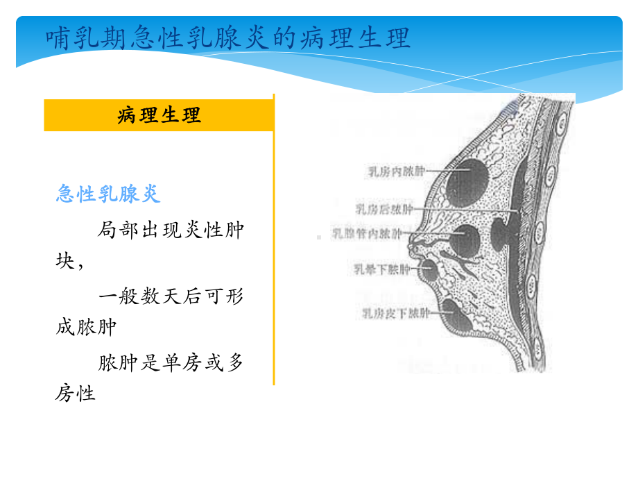 哺乳期急性乳腺炎的预防课件.pptx_第3页