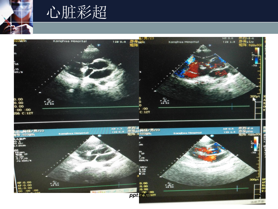 主动脉窦动脉瘤-ppt课件.ppt_第2页