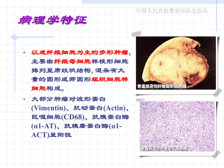 恶性纤维组织细胞瘤课件.ppt_第3页