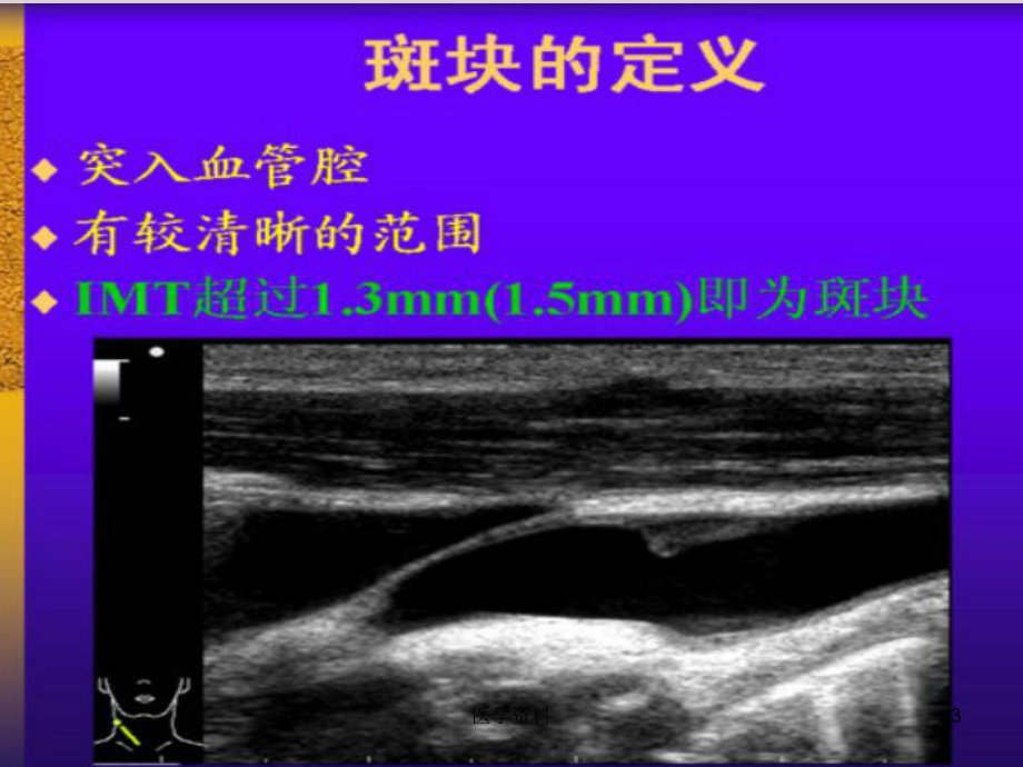 颈动脉血管超声诊断-ppt课件.ppt_第3页