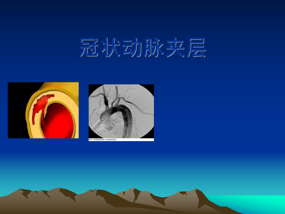 冠状动脉夹层-护理查房汇总.课件.ppt_第1页