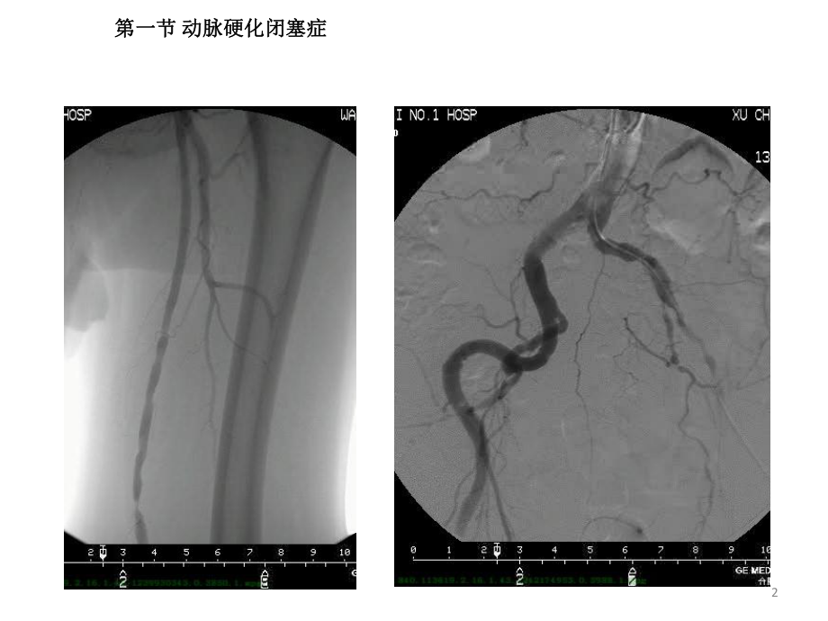 动脉硬化闭塞性疾病PPT课件.pptx_第2页