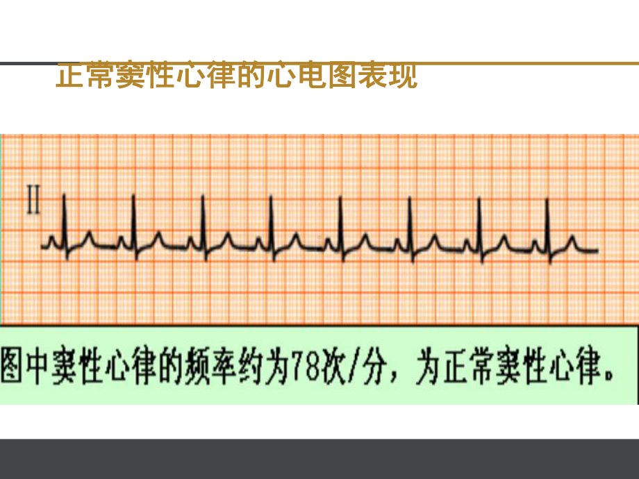 窦性心律失常-ppt课件.ppt_第3页