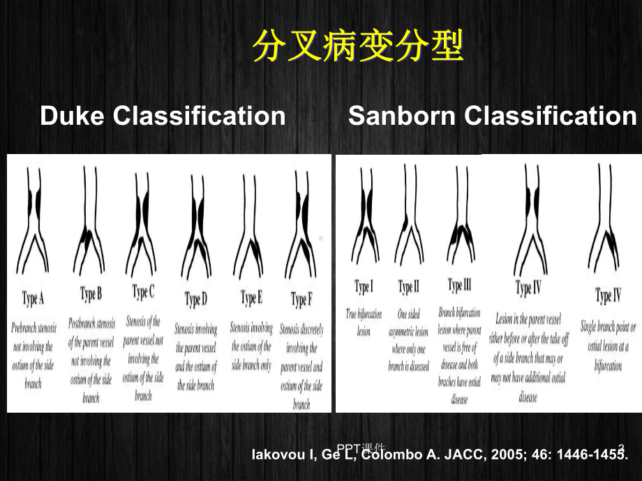 冠脉分叉病变不同介入治疗策略评价-ppt课件.ppt_第3页