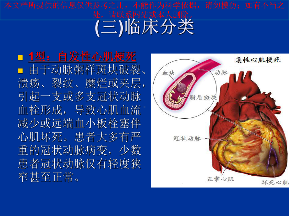 急性ST段抬高型心肌梗死诊疗和治疗指南讲解培训课课件.ppt_第3页