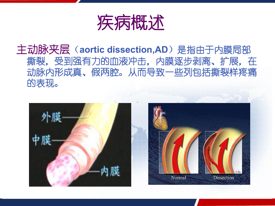 主动脉夹层腔内隔绝术的围术期护理-PPT课件.ppt_第3页