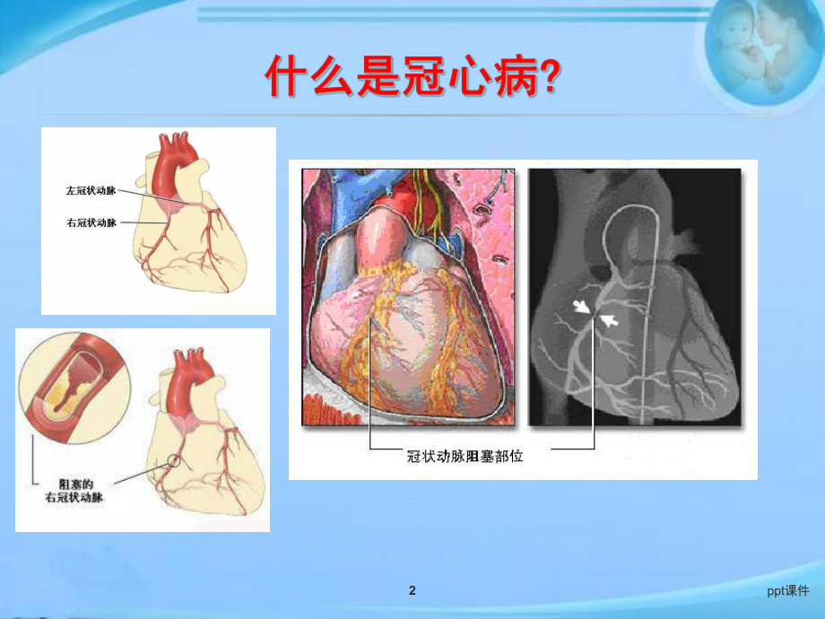 冬季冠心病防治-ppt课件.ppt_第2页